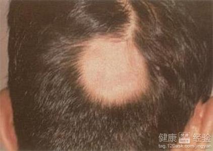 斑禿的發病機理和治療方法