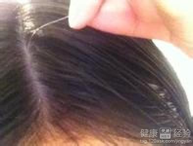 青少年白頭發怎麼辦？