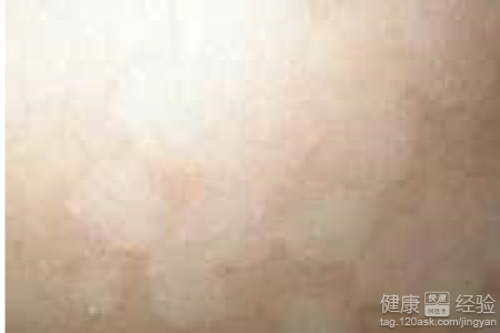 皮膚有花斑癬和扁平疣的區別