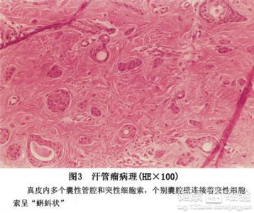 扁平疣及汗管瘤怎麼樣治