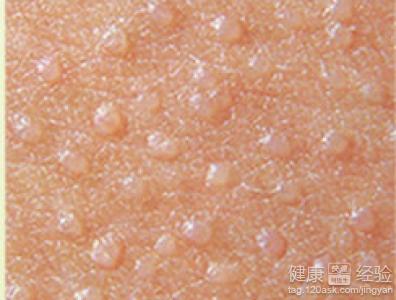 鴉膽子治療扁平疣出現紅腫水疱是什麼現象