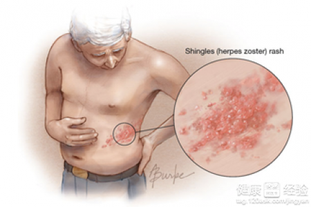 老年人帶狀疱疹怎麼預防