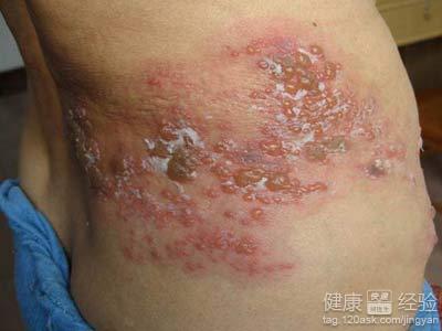帶狀疱疹是怎麼引起