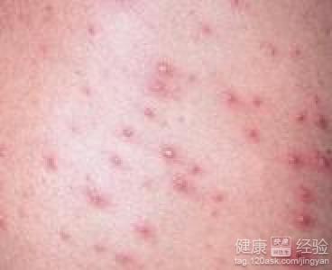 帶狀疱疹病毒是什麼