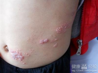 帶狀疱疹是性病嗎