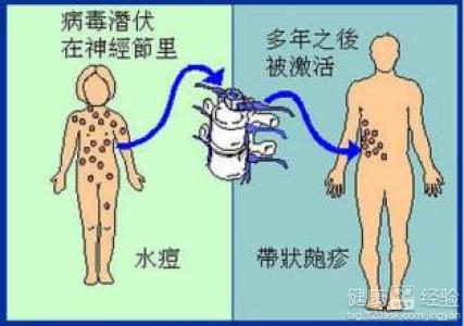 兒童帶狀疱疹的護理