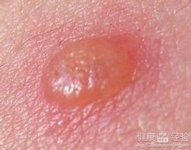 中國帶狀疱疹治療指南