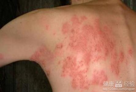 帶狀疱疹有傳染性嗎