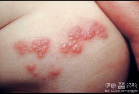 兒童帶狀疱疹症狀表現有哪些