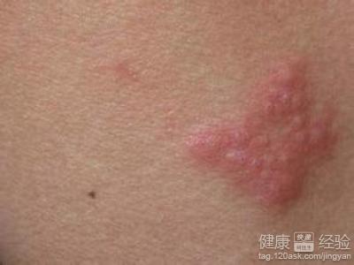 帶狀疱疹後神經疼是什麼原因呢