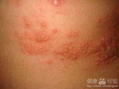 帶狀疱疹引起的疼痛和治療是什麼呢