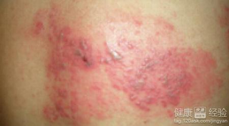 得了帶狀疱疹，皮膚什麼時候會基本痊愈呢