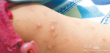 帶狀疱疹是有病毒性的嗎