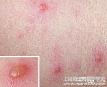 患帶狀疱疹婦女還可不可以繼續哺乳呢