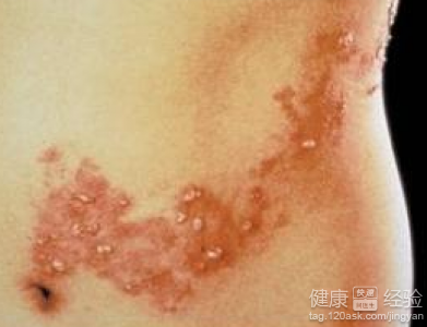 帶狀疱疹一般長在什麼位置呢