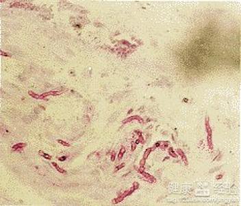 著色芽生菌病和暗色絲孢霉病有哪些症狀呢？