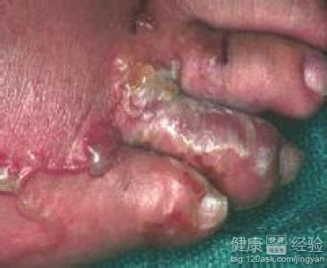 給大家分享一下鉤蟲皮炎是如何防治的
