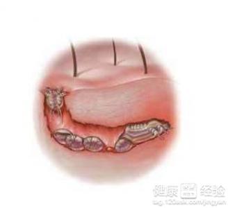 疥瘡疥瘡結節要怎麼治療