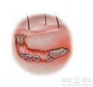 腿上的疥瘡是怎麼引起的