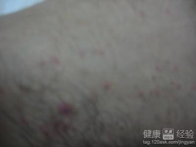 治療疥瘡期間是否能洗澡