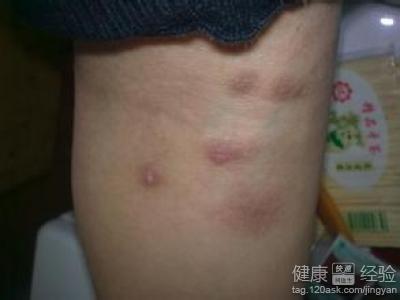 陰囊疥瘡結要注意些什麼