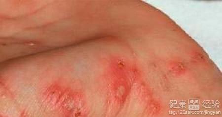疥瘡出在手指間會有什麼後果嗎