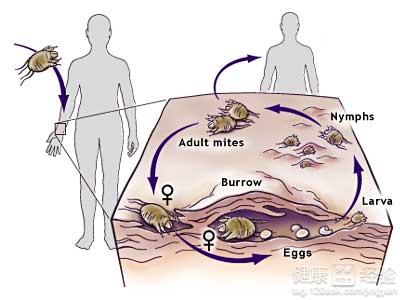 疥瘡是怎麼感染的需要怎麼醫治呢