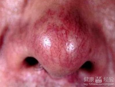 脂溢性皮炎和酒糟鼻如何治療