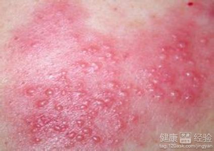 脂溢性濕疹與脂溢性皮炎的區別
