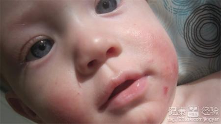 教家長寶寶起濕疹的濕疹應該怎麼辦!