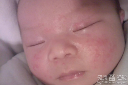 新生嬰兒寶寶得了濕疹怎麼辦