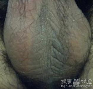 陰囊濕疹如何食療？吃什麼好