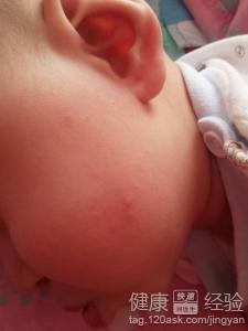 寶寶患上濕疹應該如何護理