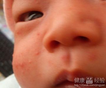 嬰兒臉上長濕疹怎麼治