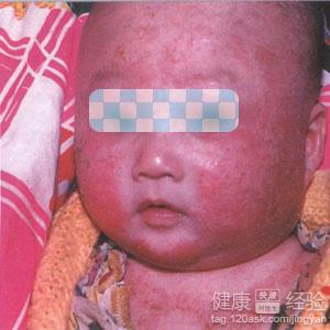 嬰兒濕疹高發3大原因