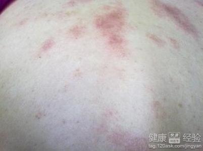 濕疹和過敏性皮炎一樣嗎?怎麼治?