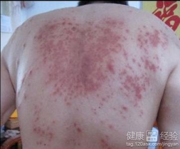 皮膚經常長濕疹怎麼辦?