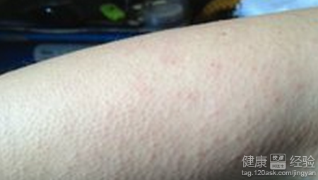 皮膚過敏引起的濕疹怎麼辦呀?
