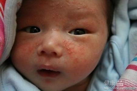 什麼是小兒濕疹