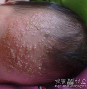 小兒濕疹發生的原因是什麼