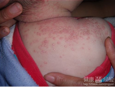 小兒濕疹怎麼治療