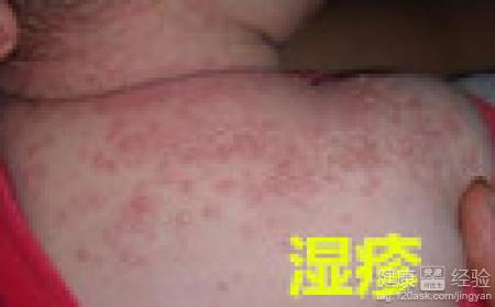小兒濕疹有哪些症狀？