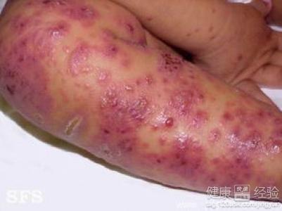 皮炎濕疹的保健措施有哪些？