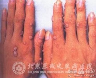 手癬和手部濕疹有什麼分別