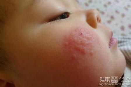 嬰兒臉上起濕疹用什麼辦法治療