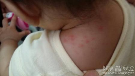 嬰兒濕疹的飲食須知