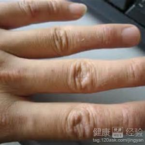 患濕雙手指瘙癢治療的妙方