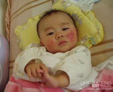 兩個月的寶寶臉上長濕疹怎麼辦