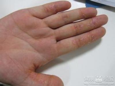 手掌裂縫濕疹要如何護理
