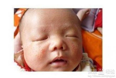 寶寶濕疹可以用艾草洗澡嗎